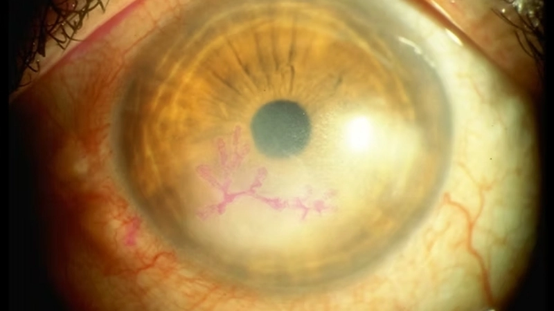 Herpetic Keratitis eye herpes symptoms guide