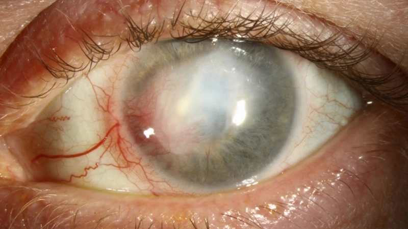 Herpetic Keratitis eye herpes treatment tips