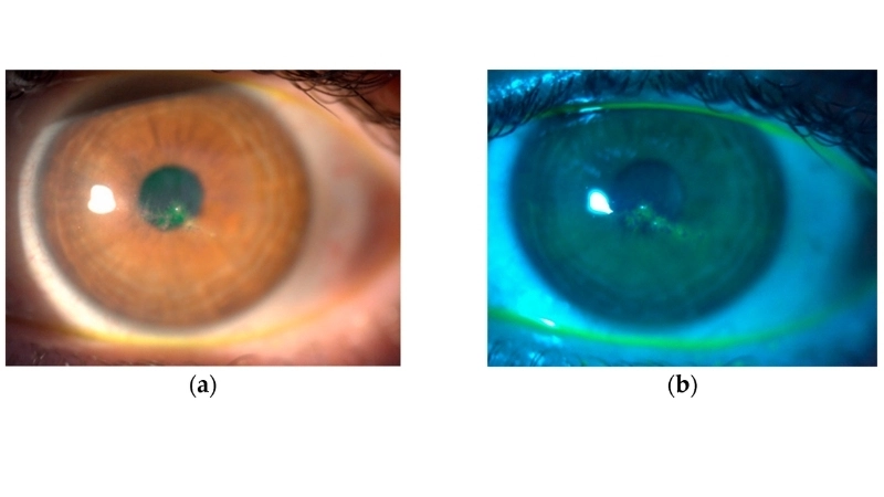 Herpetic Keratitis eye herpes pictures view