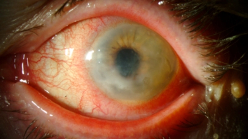 Herpetic Keratitis eye herpes eye drops use