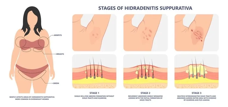 Stages of hidradenitis suppurativa condition
