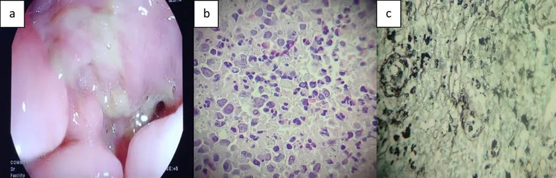 How is histoplasmosis transmitted via spores