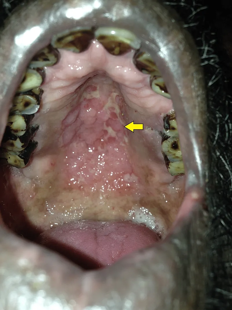 CT scan showing signs of adrenal histoplasmosis