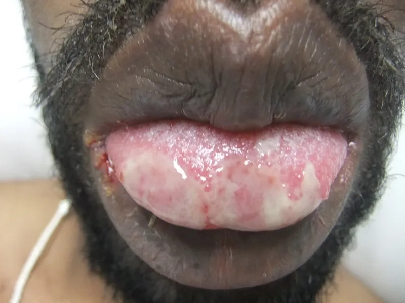 Doctor examining a histoplasmosis eye infection