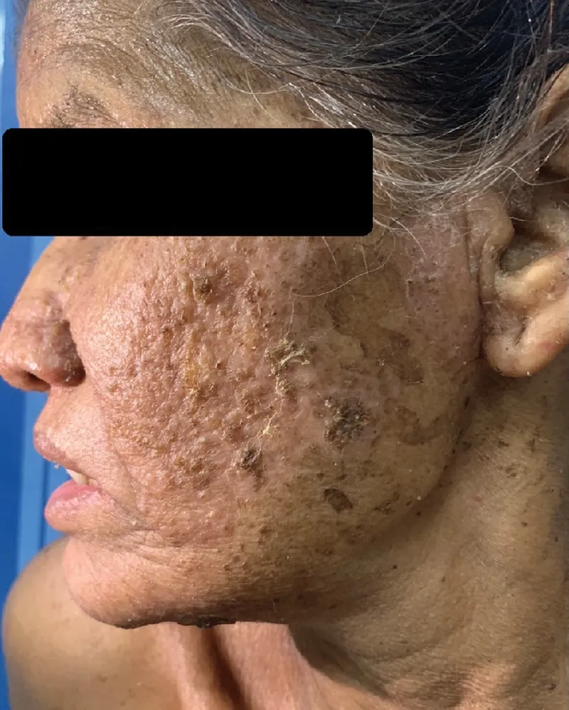 A positive histoplasmosis antigen test result