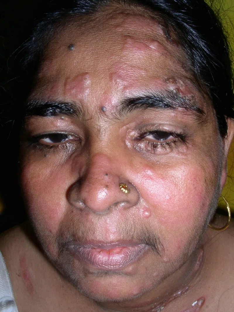 Histoplasmosis and blastomycosis under a microscope