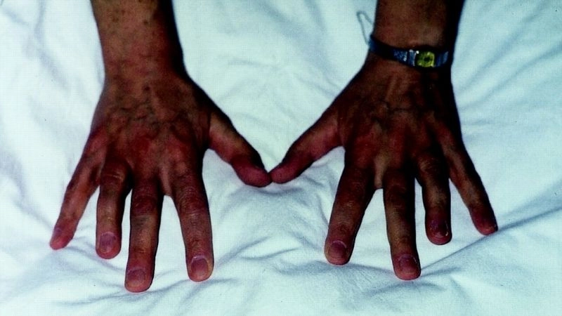 Holt-Oram syndrome inheritance patterns explained