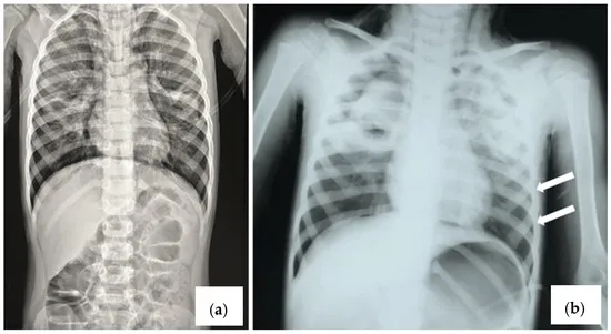 Exploring effective bocavirus treatment options