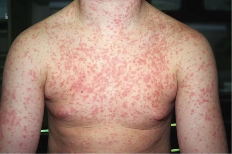 The current status of research on if HIV can be cured