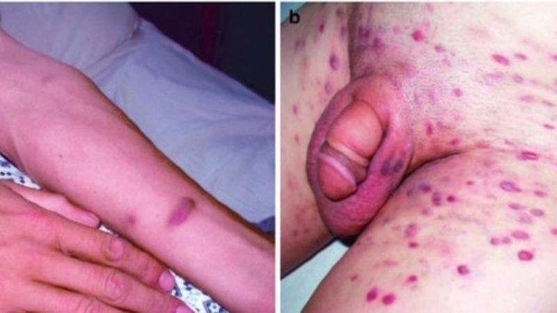 Human Immunodeficiency Virus HIV Infection AIDS HIV vaccine research