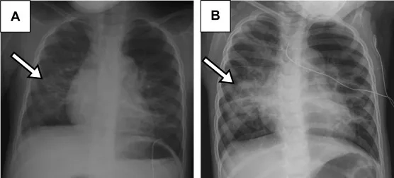 Is human metapneumovirus dangerous for young children