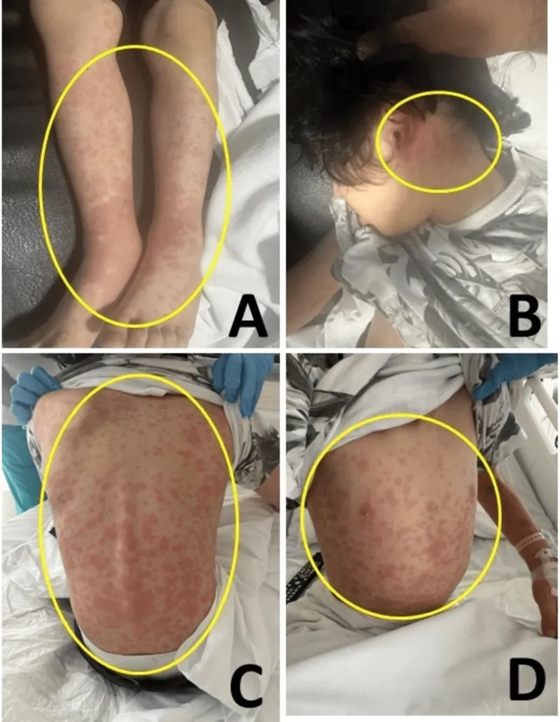 Understanding how do you get human metapneumovirus