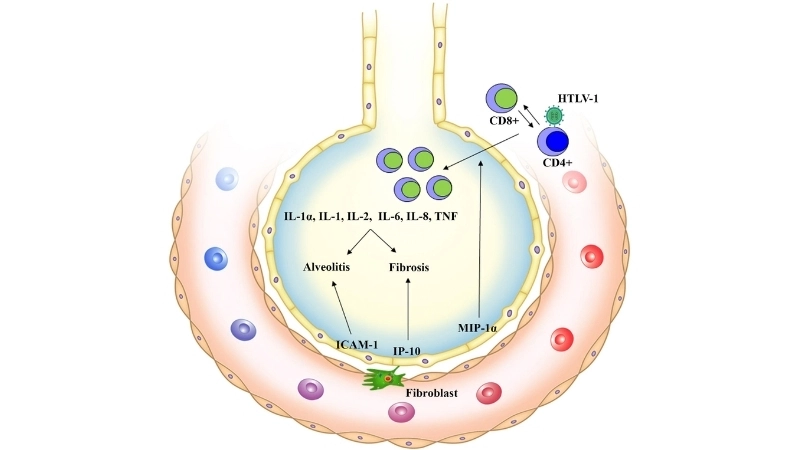 Human T-lymphotropic Virus infection HTLV-3
