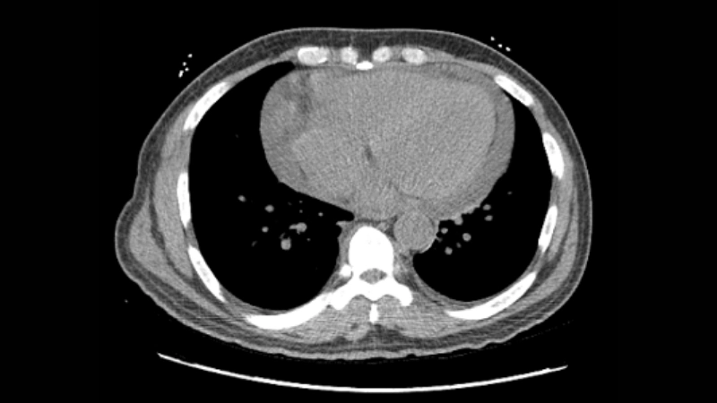 Human T-lymphotropic Virus infection adult T-cell leukemia lymphoma