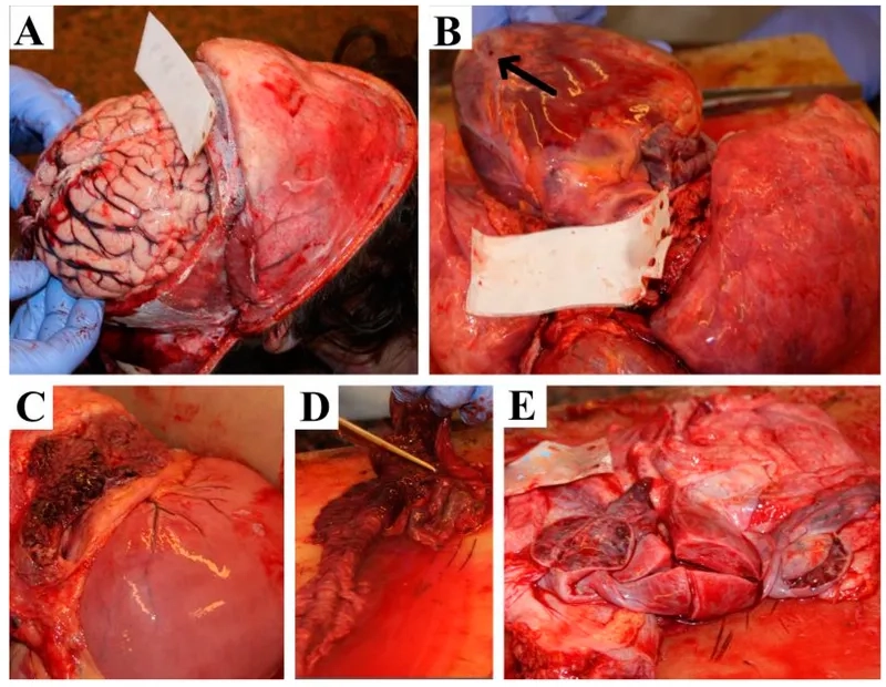 Thyroid storm and life threatening complication