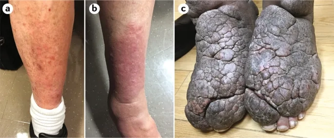 Hyperthyroidism treatment and care approaches
