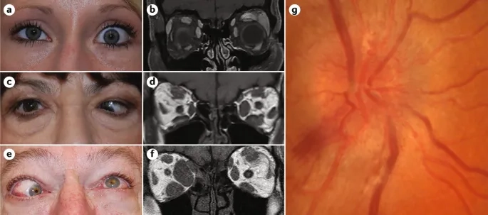Radioactive iodine therapy for thyroid disorders
