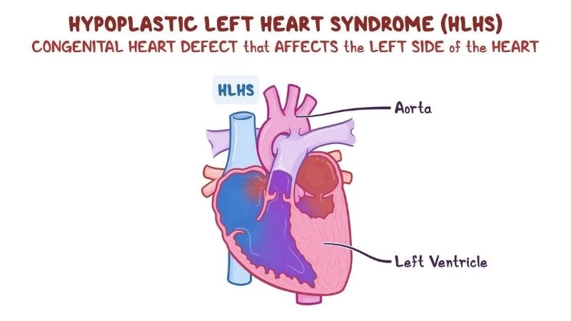 Hypoplastic left heart syndrome causes understanding the condition