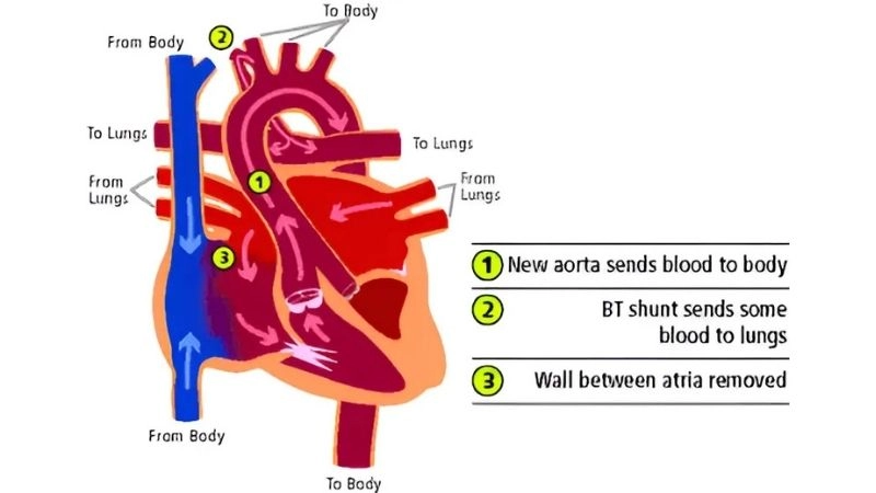 Glenn procedure second stage palliation for single ventricle