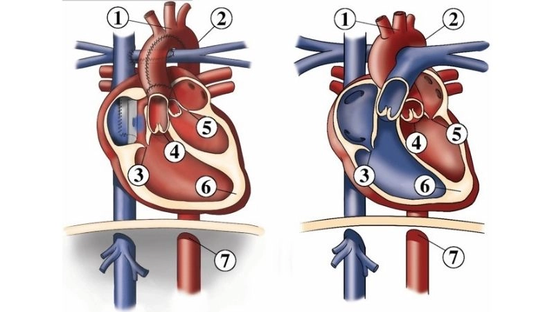 Single ventricle heart defect challenges and management