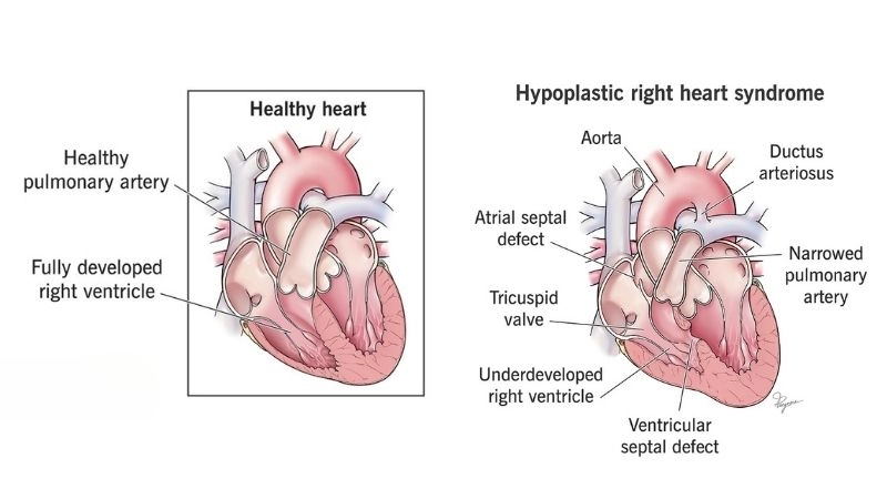 Hypoplastic right heart syndrome treatment medical and surgical care