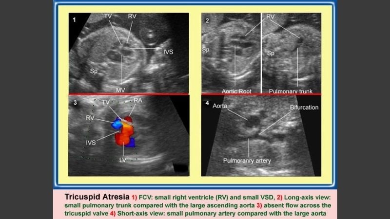 Hypoplastic right heart syndrome fetal diagnosis before birth detection