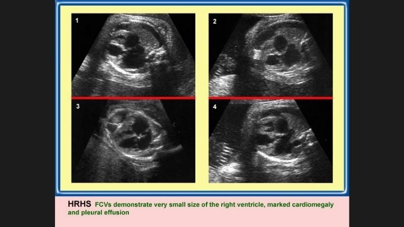 Hypoplastic right heart syndrome in adults rare long term cases