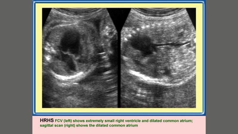 Hypoplastic right heart syndrome life expectancy survival outlook