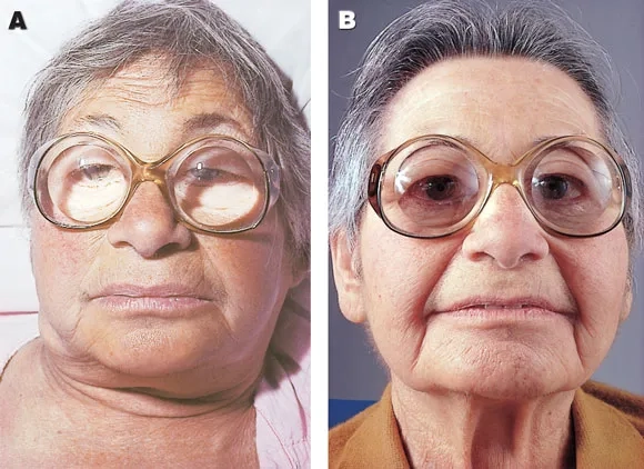 Medical diagram explaining underactive thyroid condition