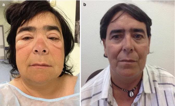 Research article discussing causes of hypothyroidism