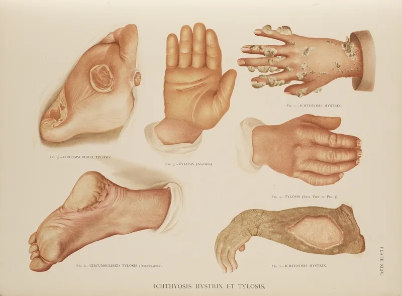 Skin condition photo showing ichthyosis vulgaris