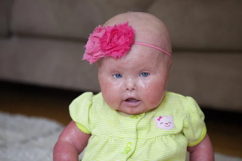 Medical illustration answering what is ichthyosis