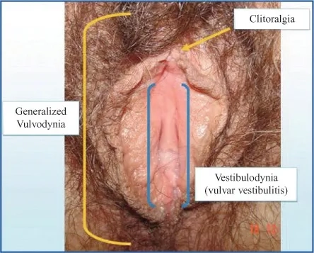 Vulvodynia causes and contributing medical factors