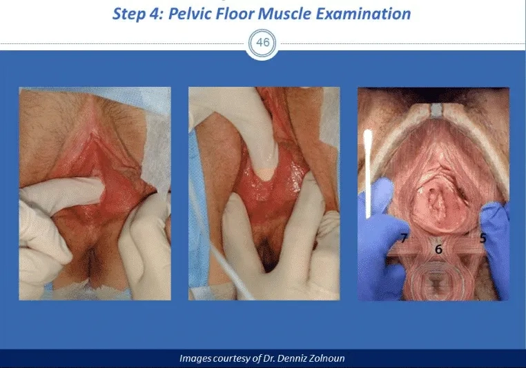 Vestibulodynia and localized vulvar pain condition