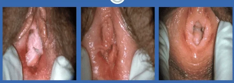 Living with vulvodynia and daily life challenges