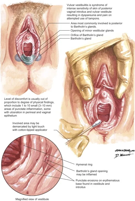 Vulvodynia symptoms and health warning signs