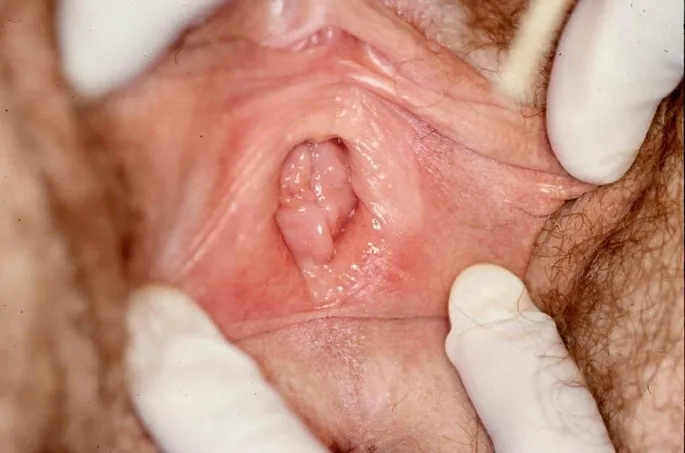 Pudendal neuralgia and chronic pelvic pain