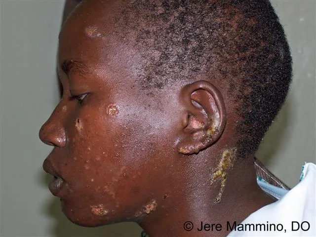 Applying an effective impetigo treatment cream