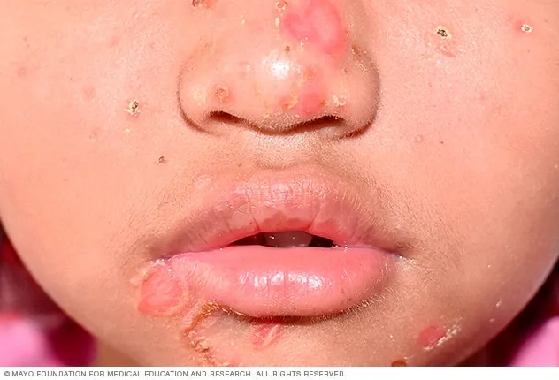 Clear clinical pictures of impetigo lesions