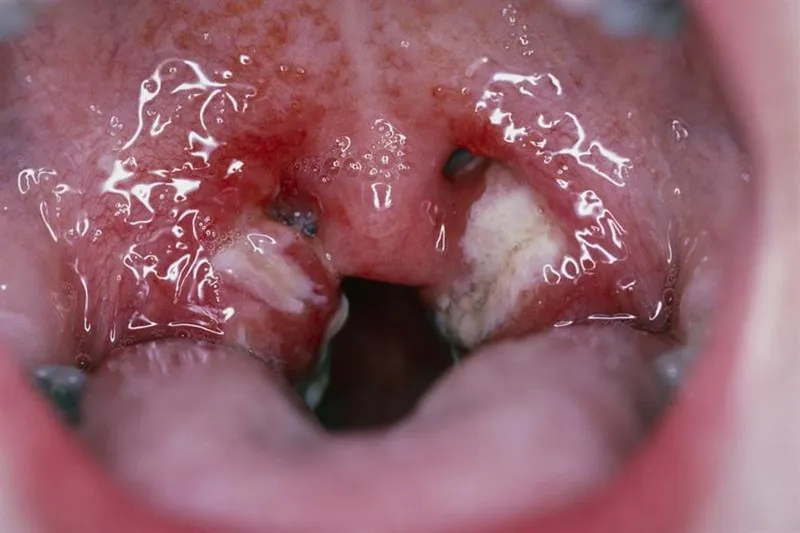 Recognizing the Key Mononucleosis Symptoms