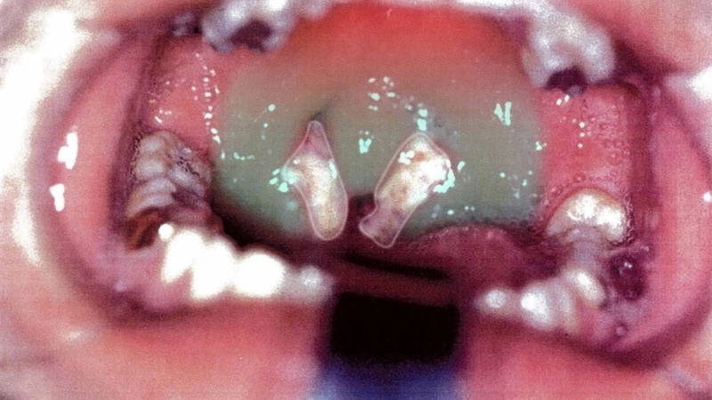 Infectious Mononucleosis signs of glandular fever rash