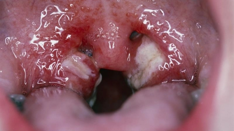 Infectious Mononucleosis linked to epstein-barr virus