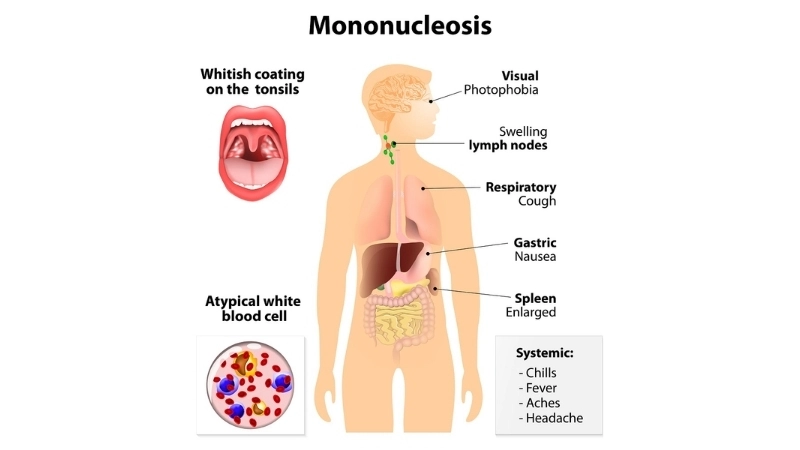 Infectious Mononucleosis Glandular Fever symptoms guide