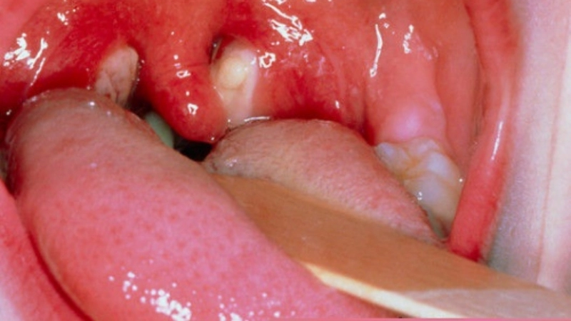 Infectious Mononucleosis called kissing disease widely