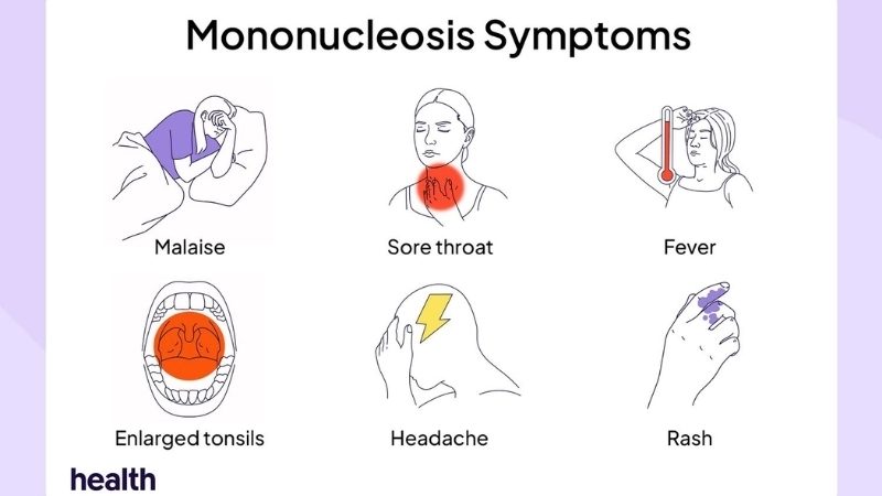 Infectious Mononucleosis mono treatment options shared