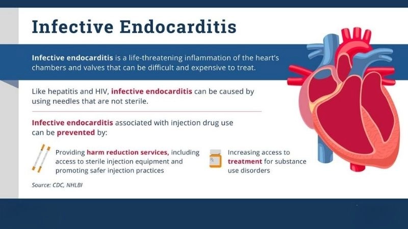 Infective endocarditis treatment medical and surgical management