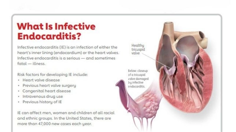 Infective endocarditis diagnosis accurate detection of condition