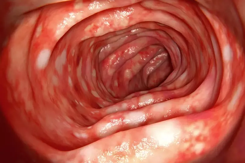 An illustration of Crohn's disease in the small intestine