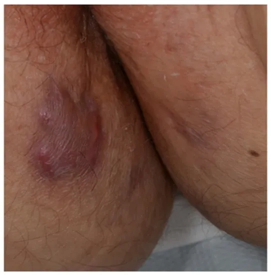 How biologics for IBD work in the body