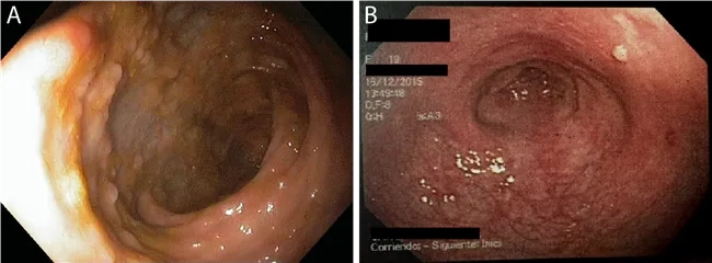 Defining what is inflammatory bowel disease